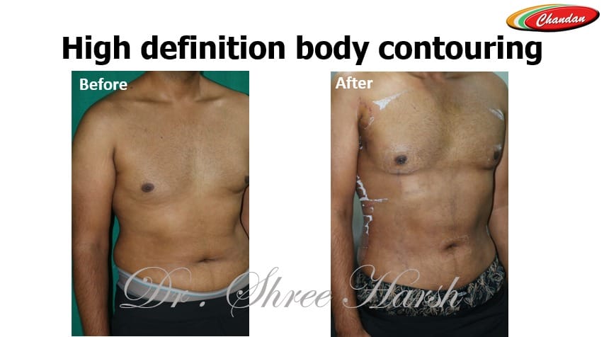 Hi-definition body contouring using power-assisted liposuction front view