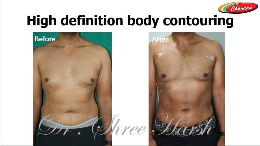 High-definition body contouring using power-assisted liposuction front view