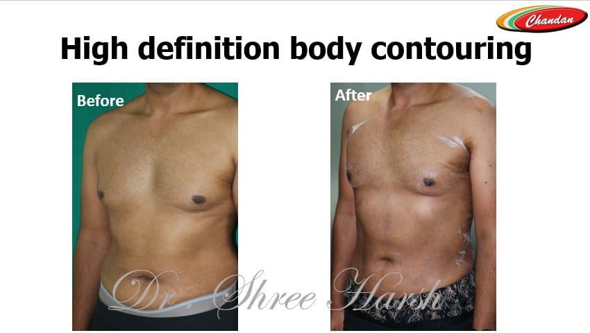 High-definition body contouring using PAL