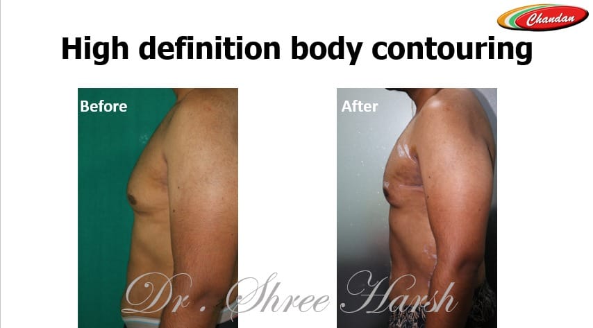 Power-assisted liposuction left side view
