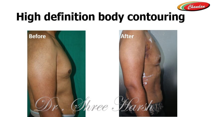 Power-assisted liposuction right side view