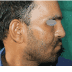 Rhinoplasty