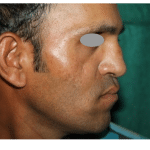 Rhinoplasty