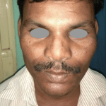 Rhinoplasty