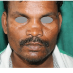Rhinoplasty