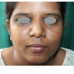 Rhinoplasty