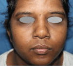 Rhinoplasty
