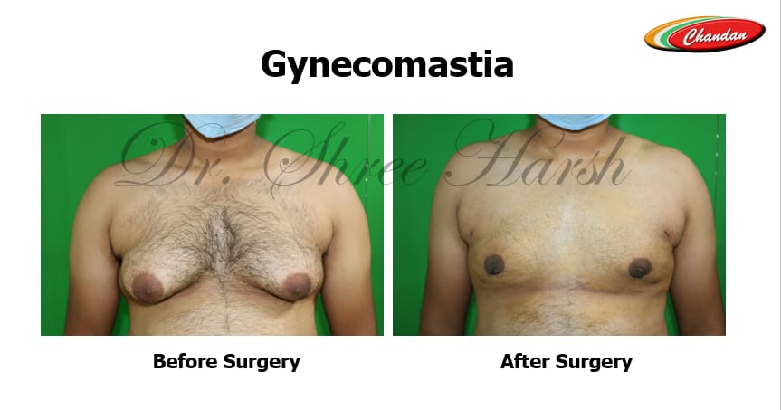 Gynecomastia