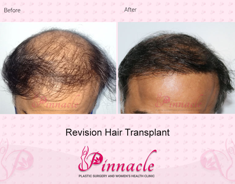Hair Transplant