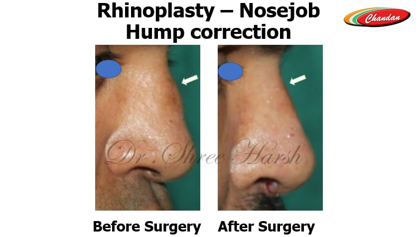 Rhinoplasty