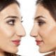 Rhinoplasty before and after results
