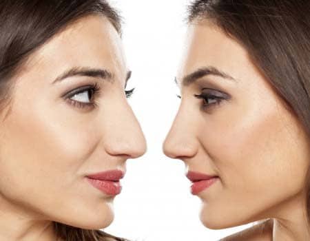 Rhinoplasty or Nose Job: How to decide if Rhinoplasty Surgery is for you?