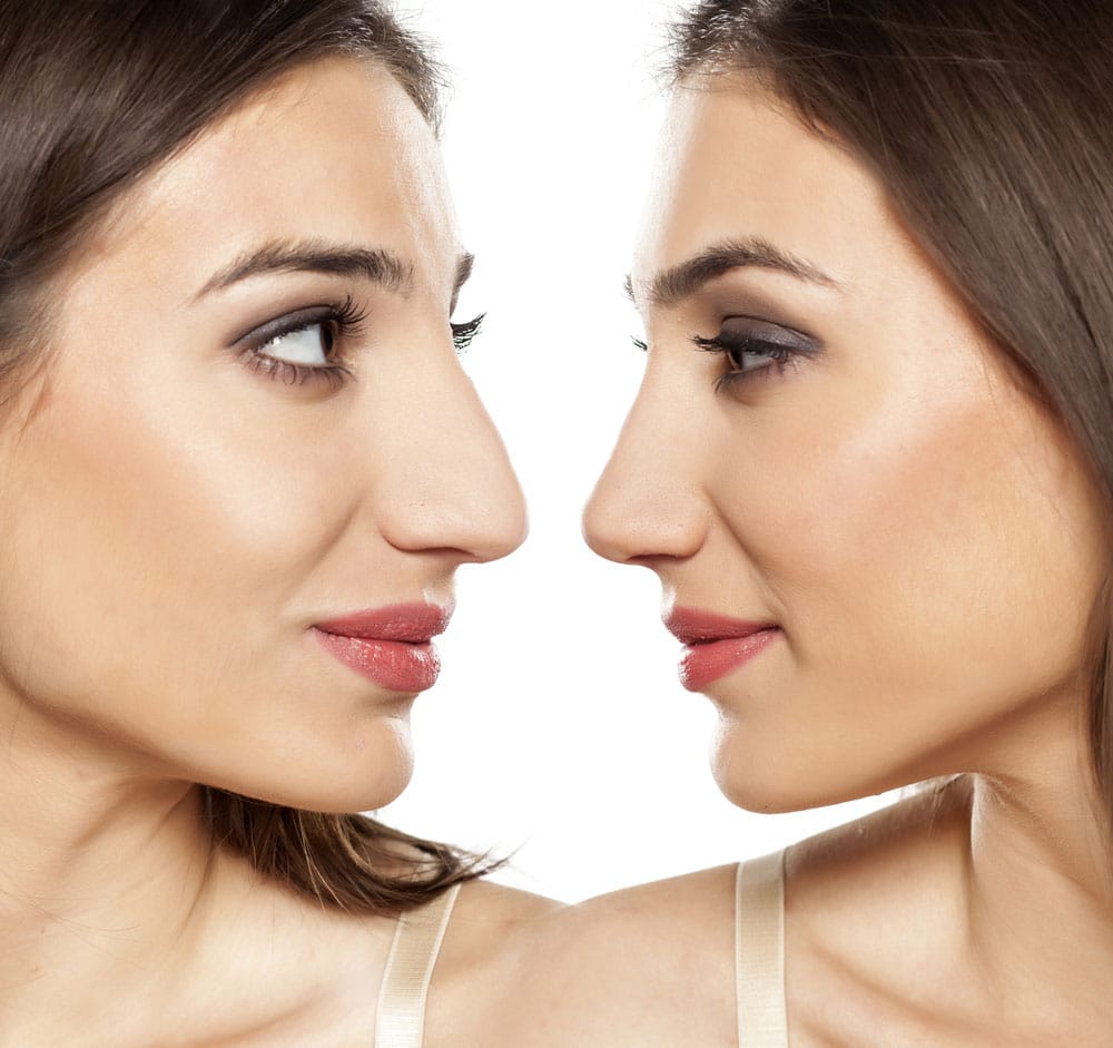 rhinoplasty before after results