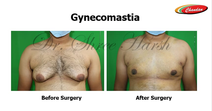 Case 1 : Gynecomastia