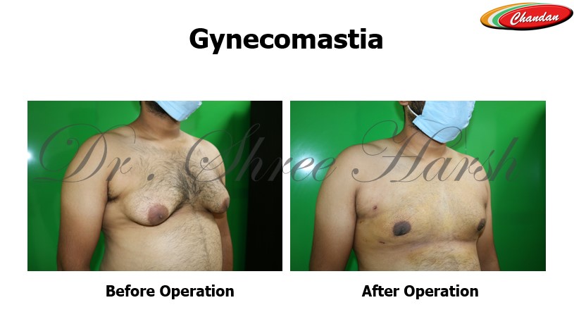 Case 2 : Gynecomastia