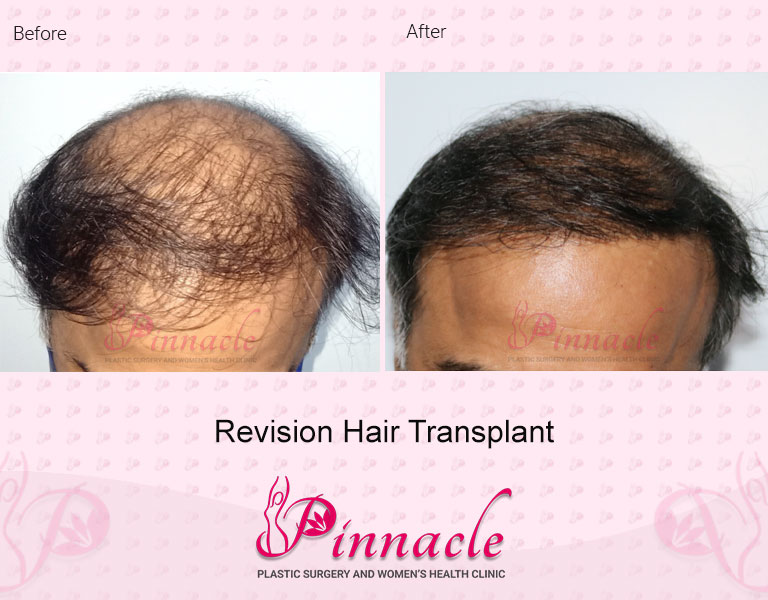 revision-hair-transplant-before-after by Dr. Shree Harsh